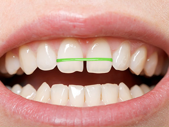 Brace yourself: DIY orthodontics can cost more than just money