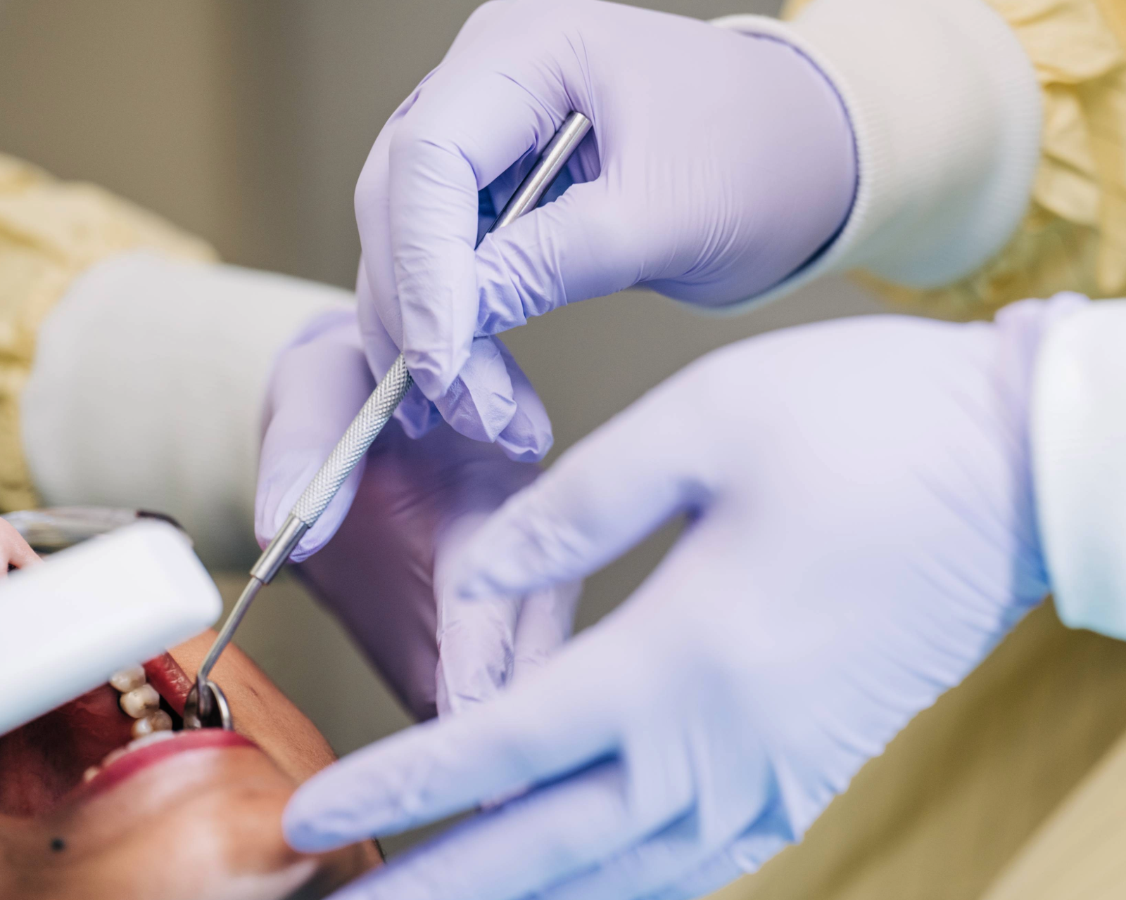 Dentists' hands working in patient's mouth.