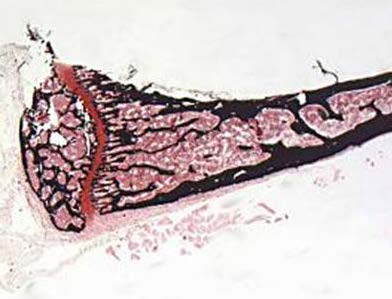 Figure 1.3 Human stented vessel with thrombus ground section methylene blue basic fuchsin stain
