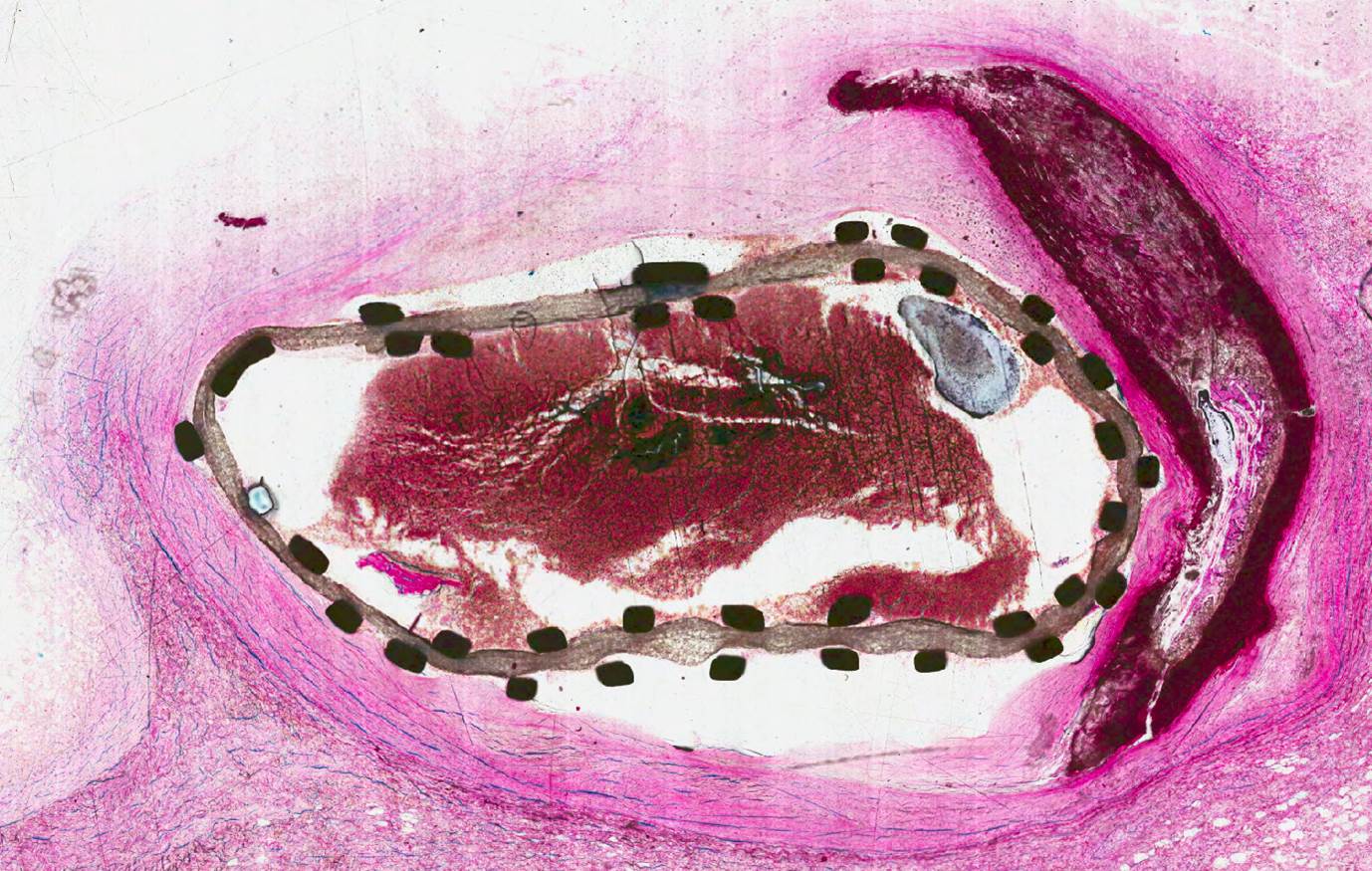 Figure 2 human stented vessel