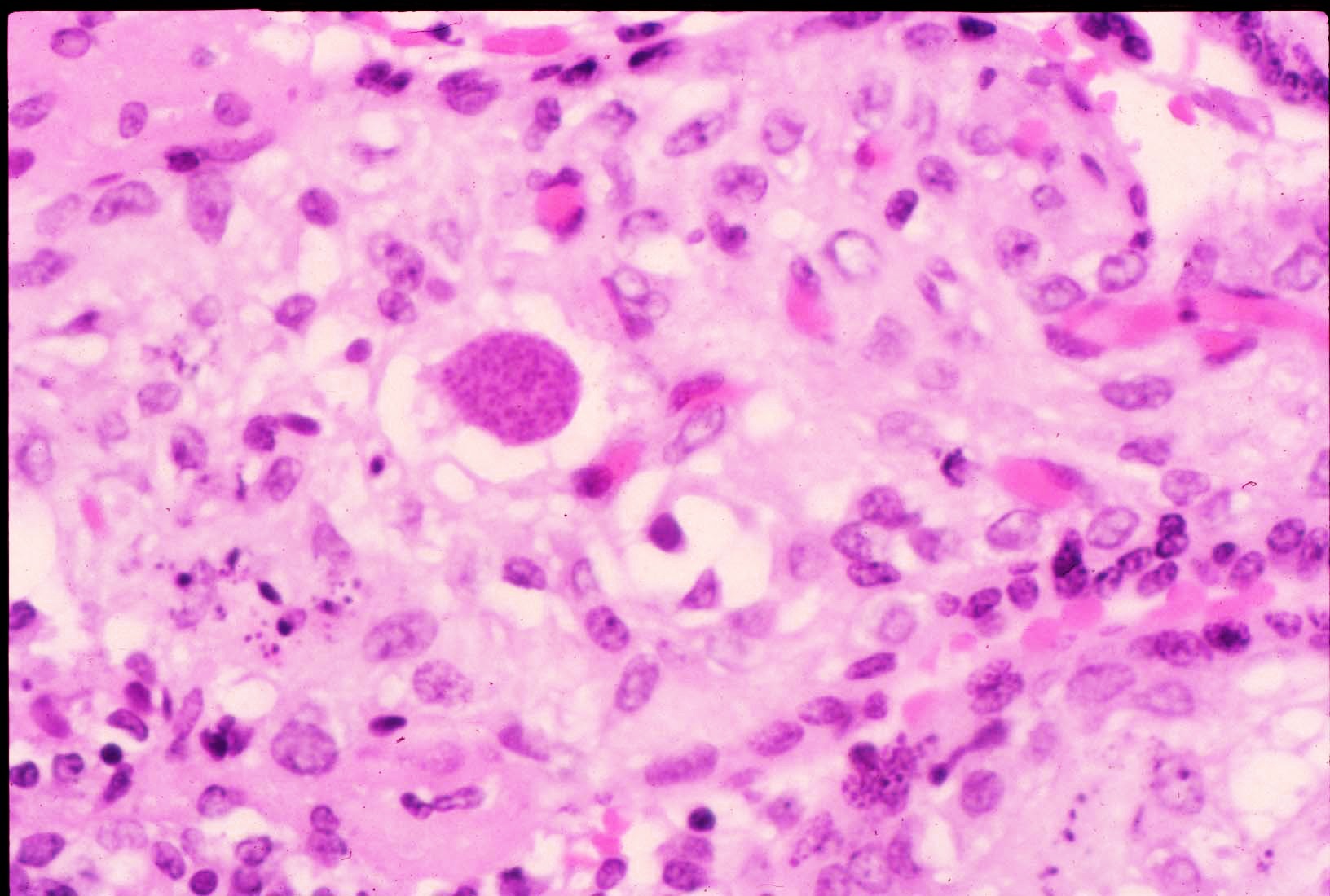 FIG 12 Toxo in Chorionic villus