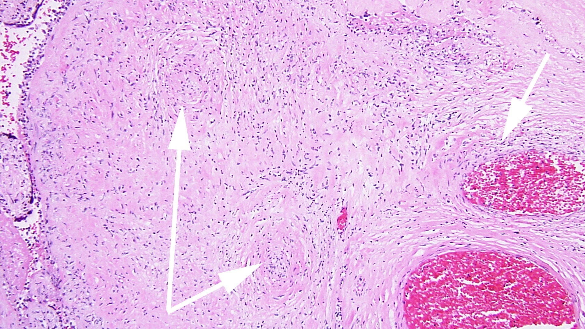 FIG 3a arrow DIFFUSE HIGRD VUE w STEM V VASCULITIS HI POW