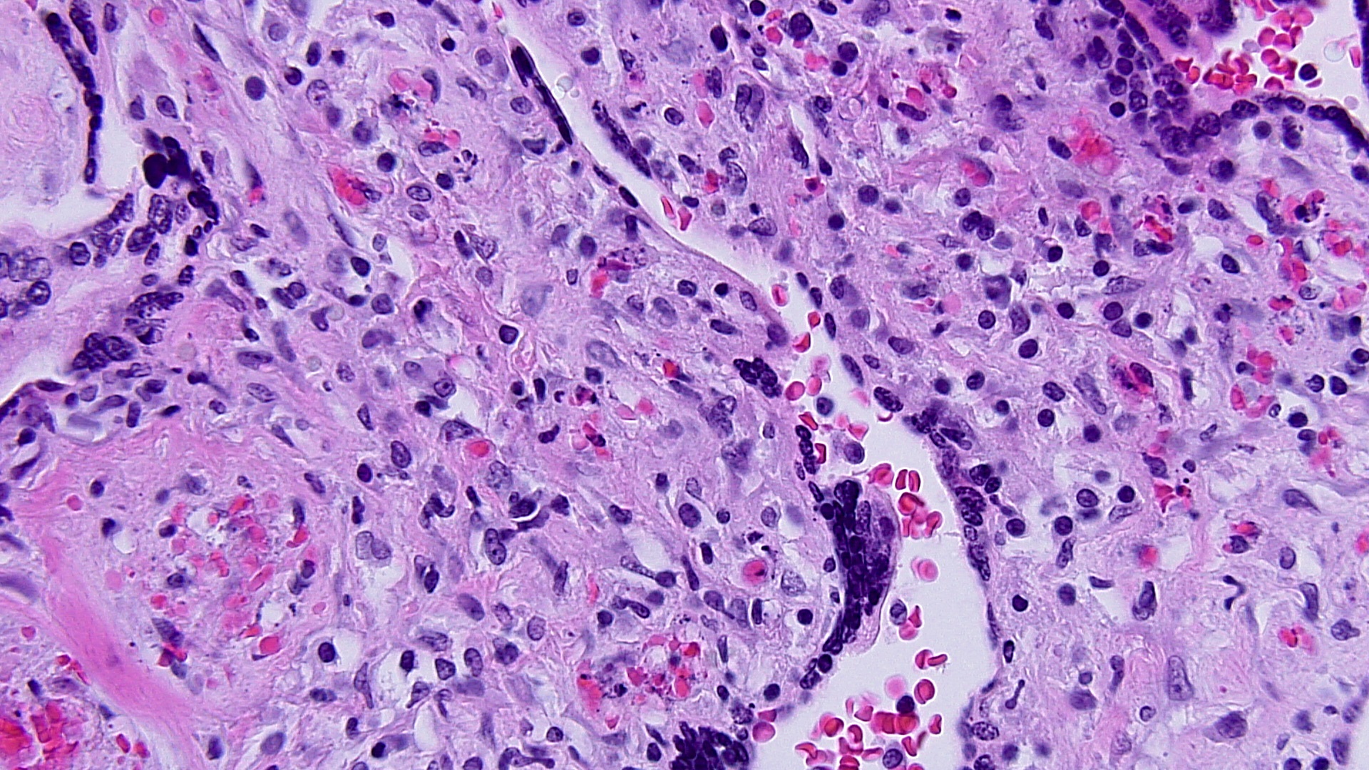 FIG 5 VUE HP KARORRHEXIS EARLY CHNG