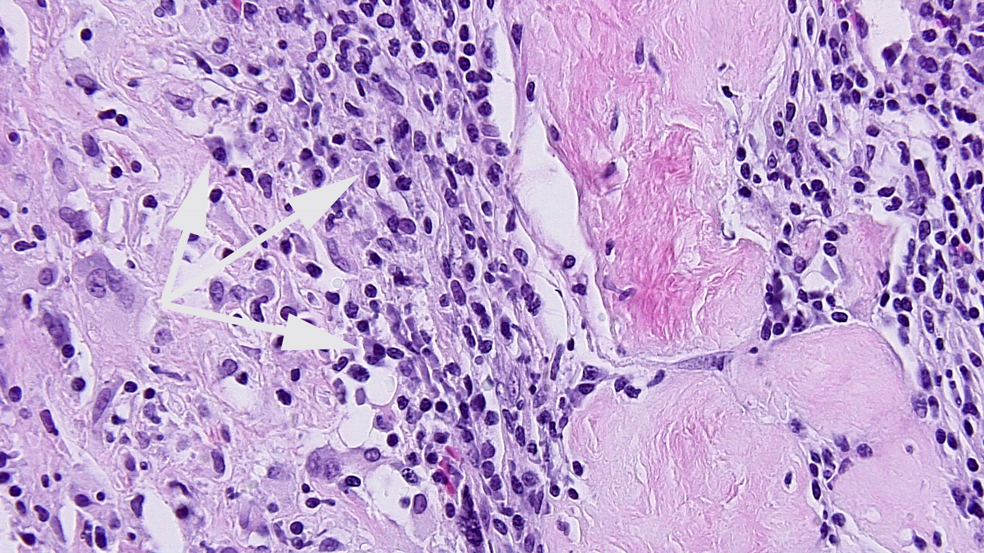 FIG 6 LP INFILTRATE IN DECID BASAL HIPOW