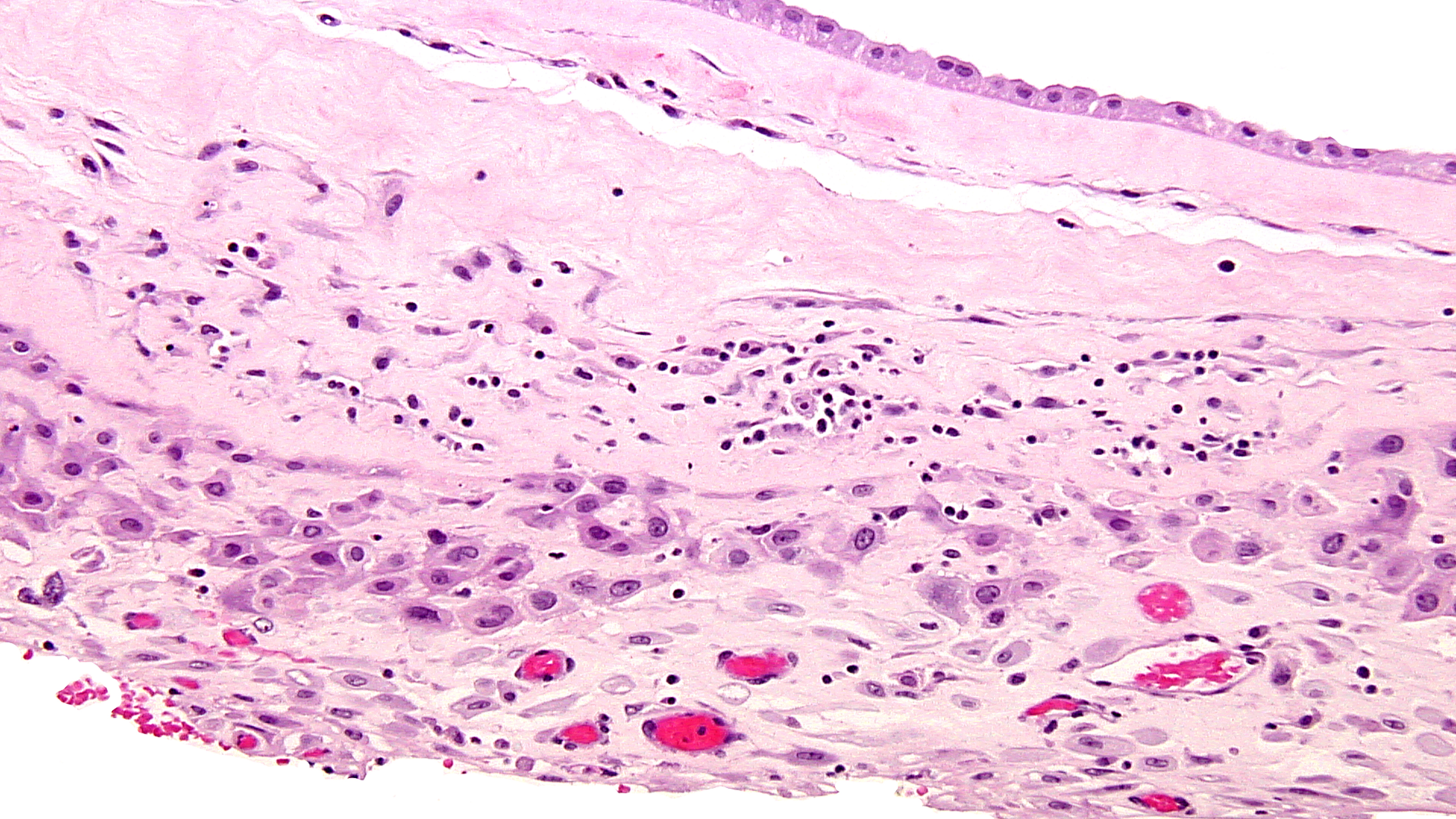 FIG 7 chronic chorio 2