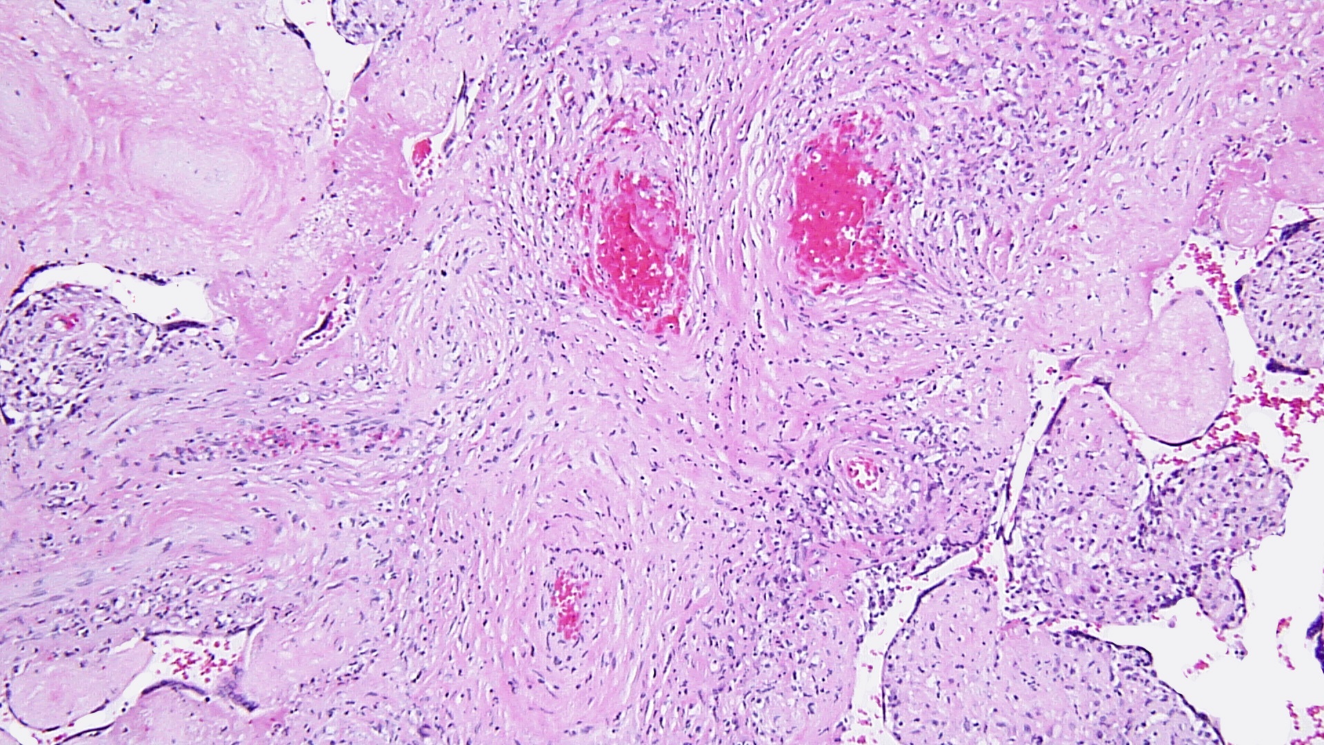 fig 4 DIFFUSE HIGRD VUE w STEM V VASCULITIS MEDPOW