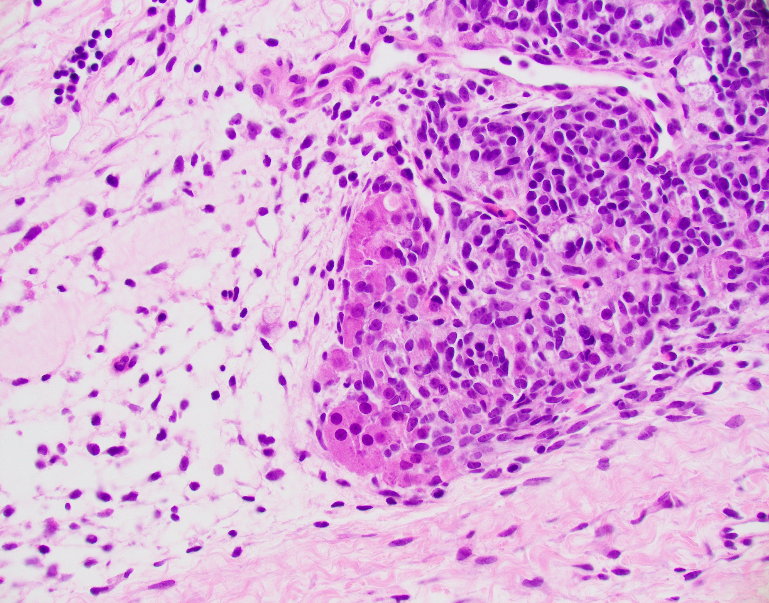 Aspirate.jpg