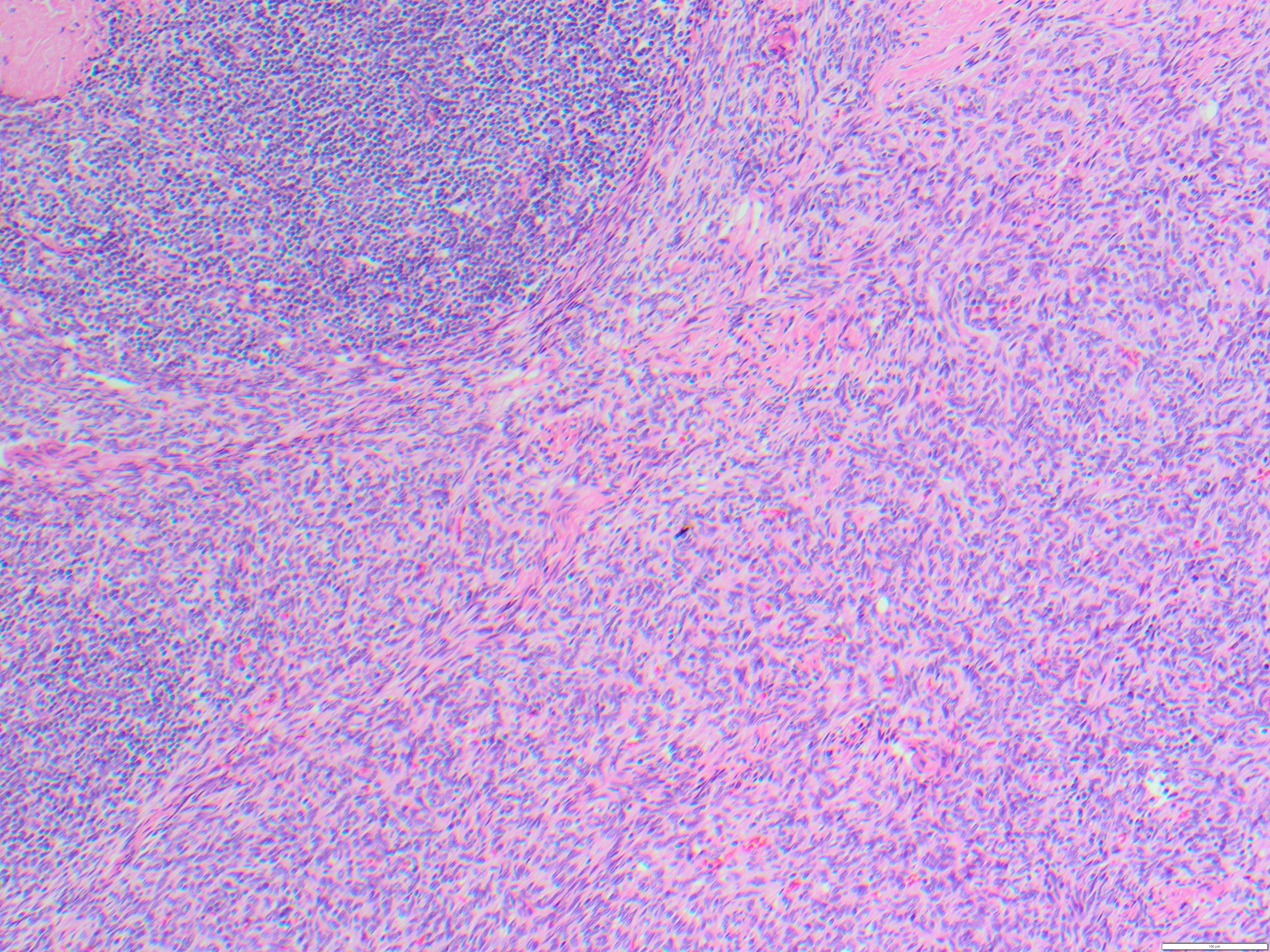 thymoma2