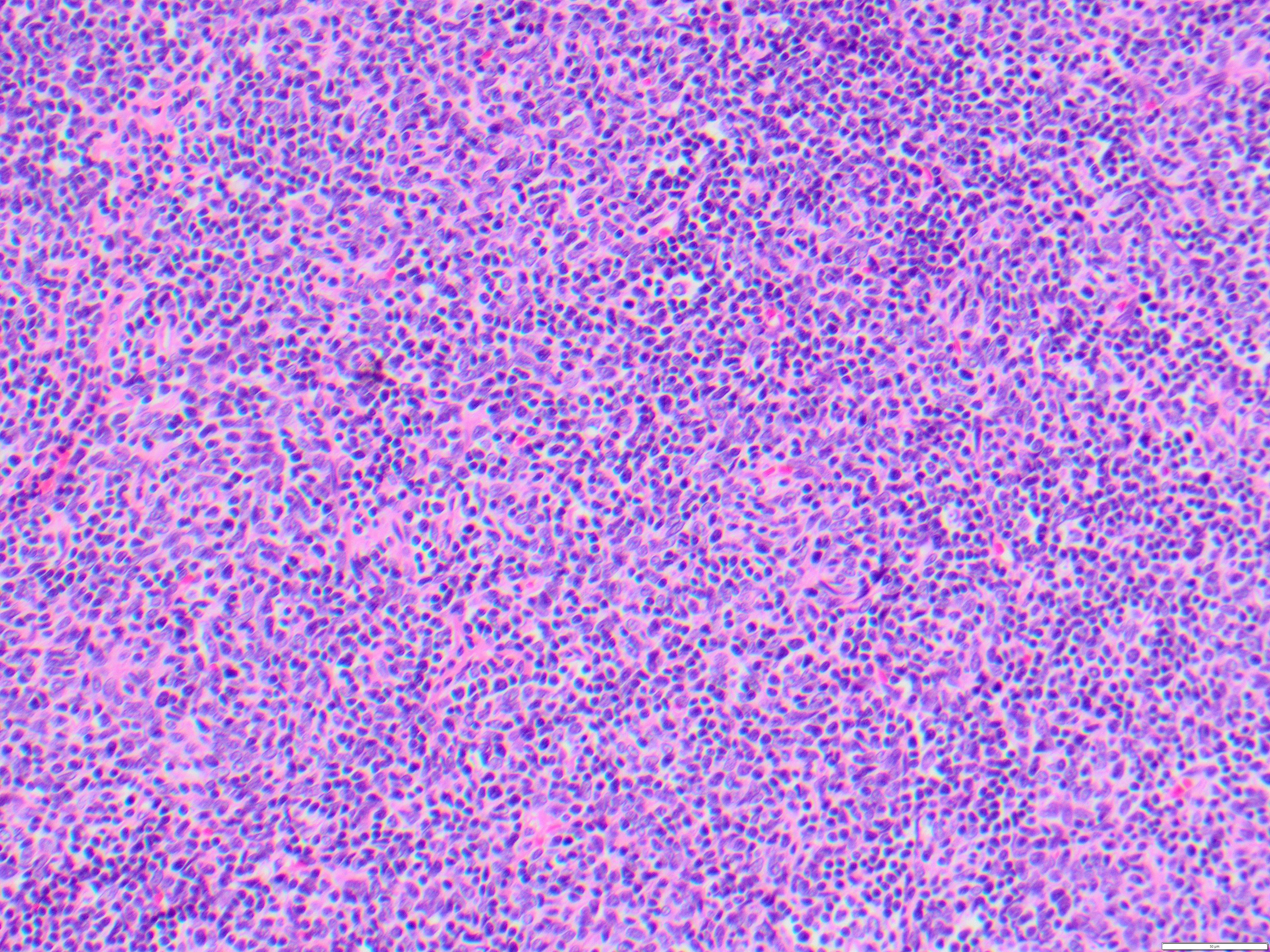 thymoma3