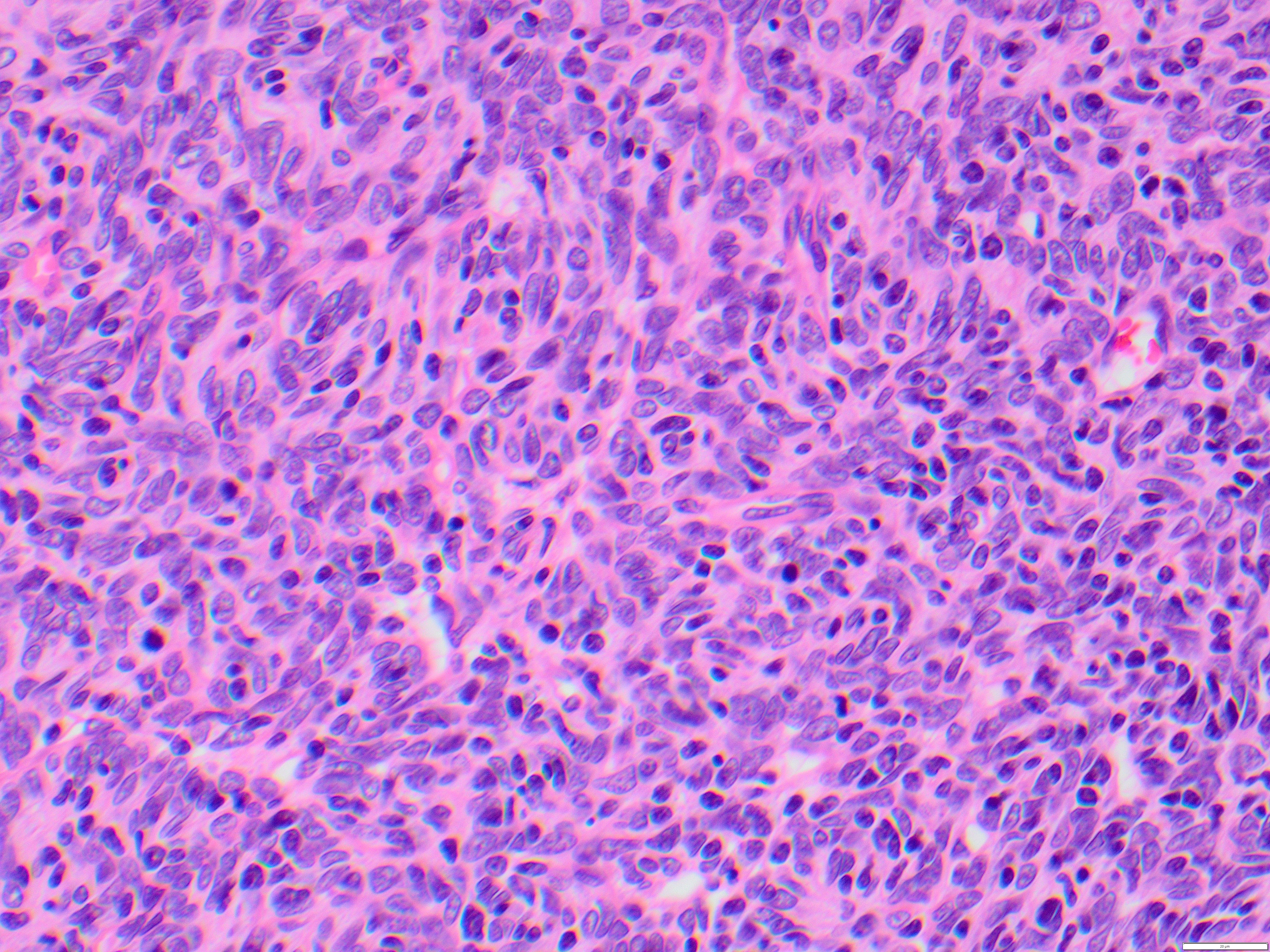 thymoma4