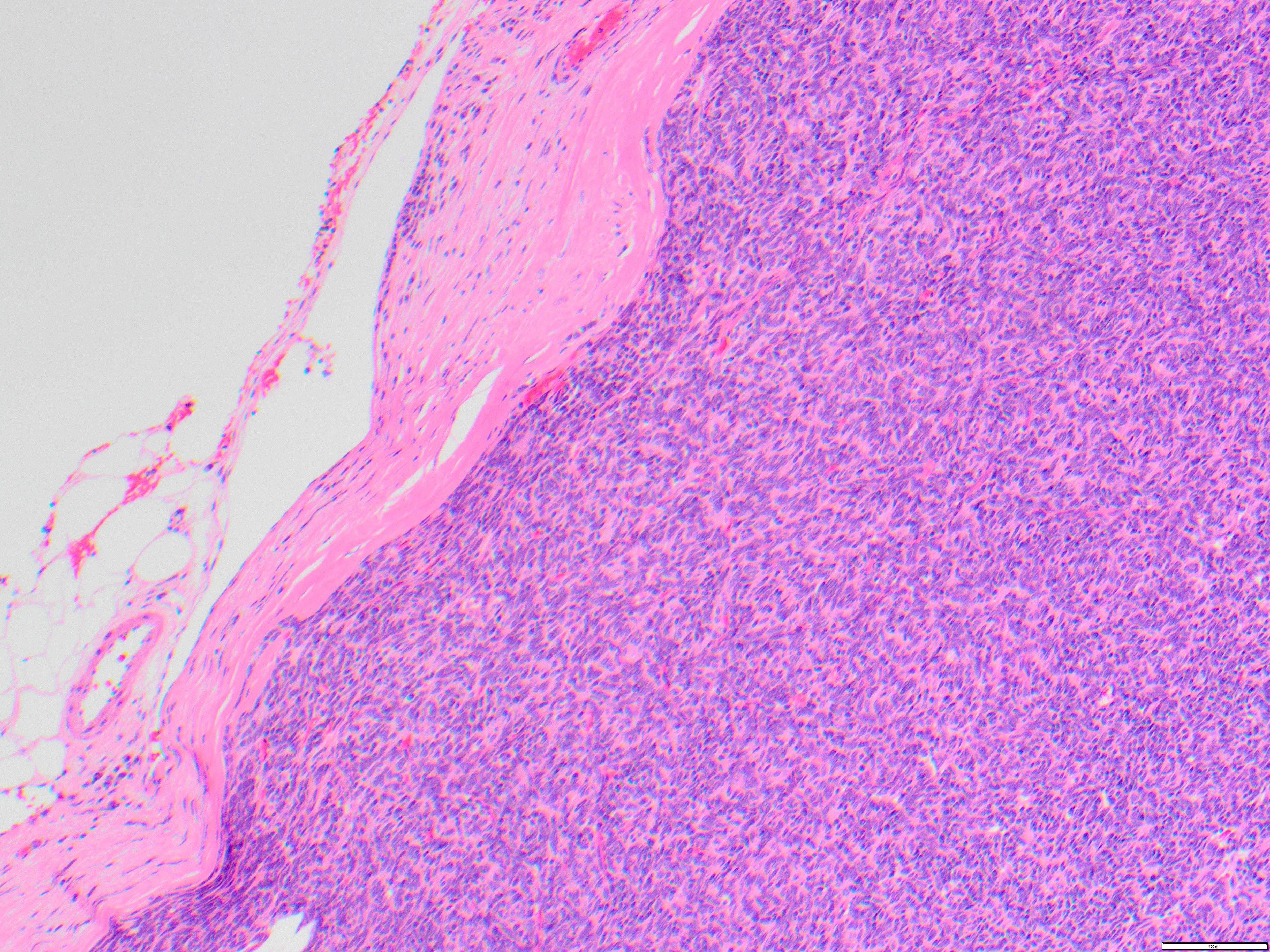 thymoma 1