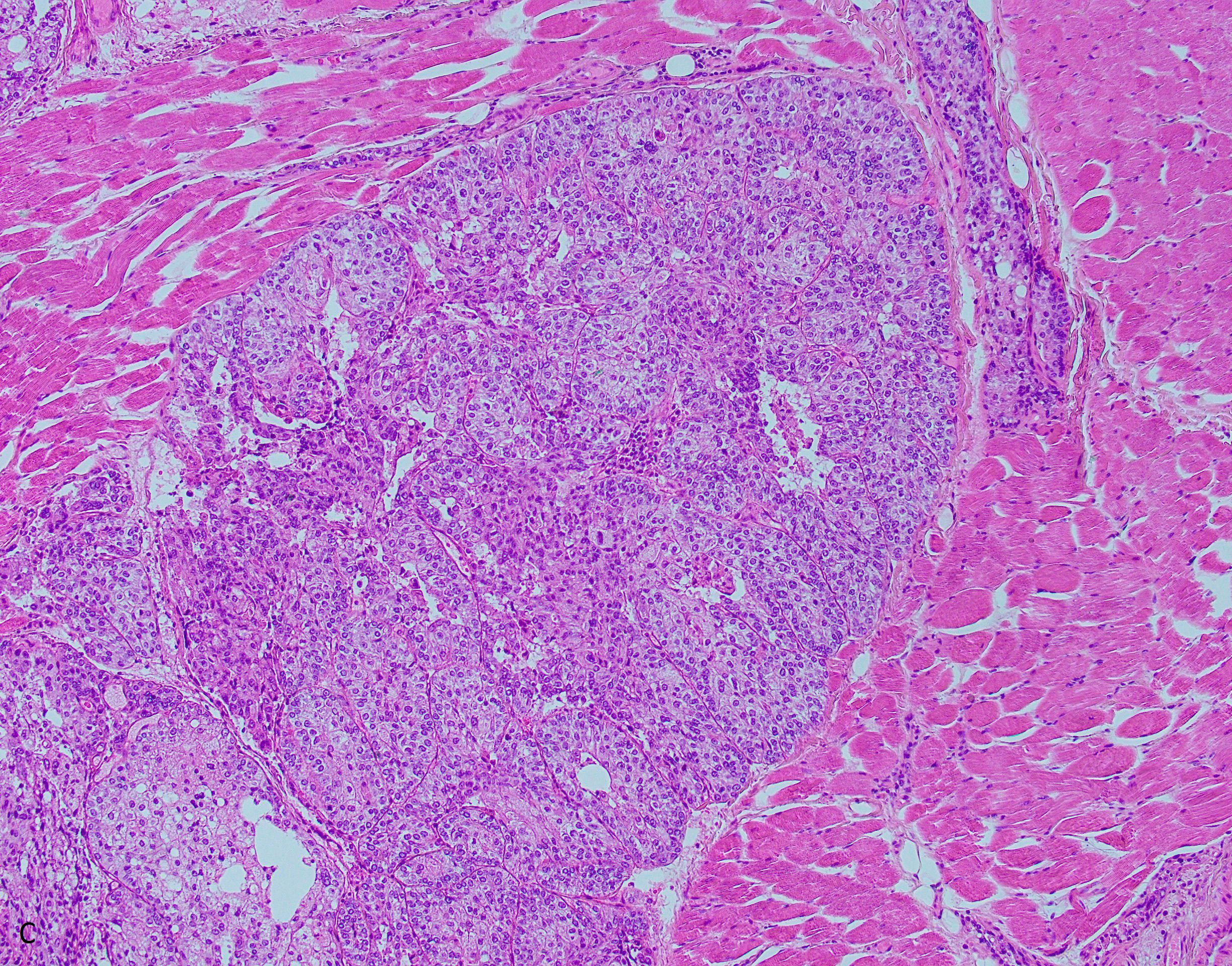 Sebaceous Carcinoma 10x 2
