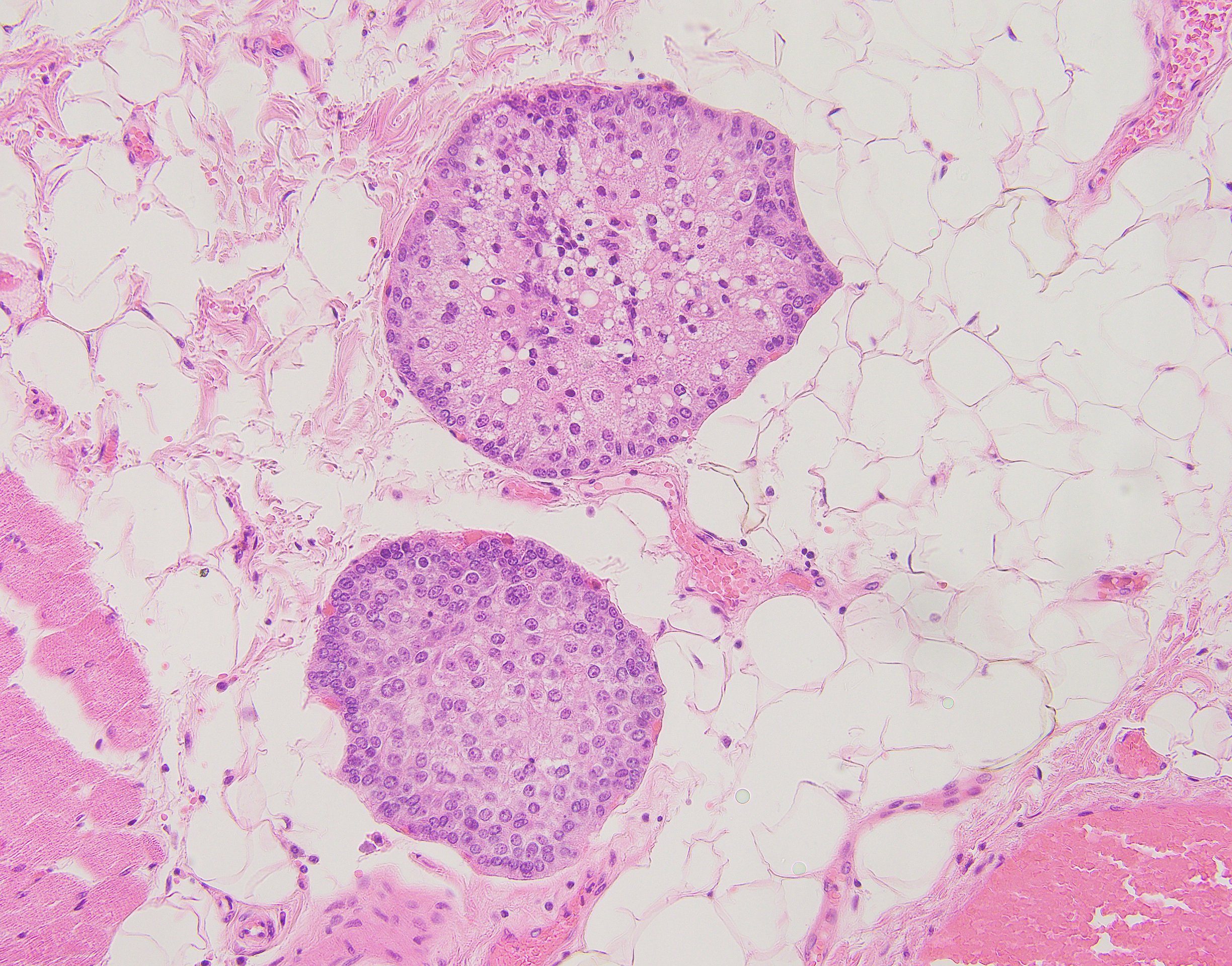 Sebaceous Carcinoma 20x