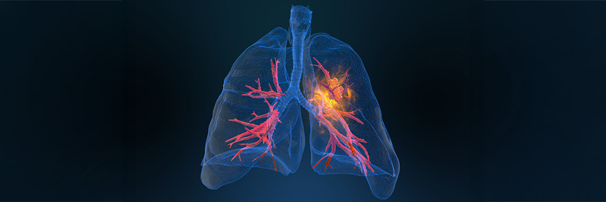 lung cancer update header