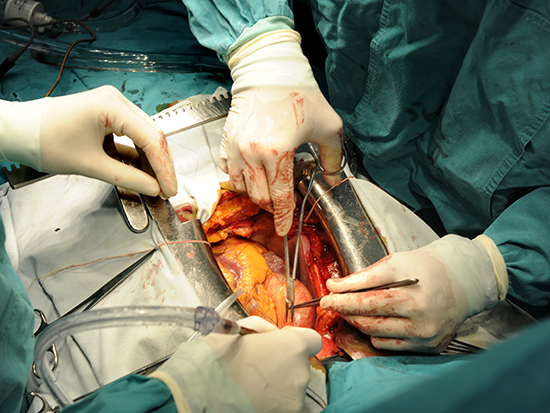 Stream open heart surgery