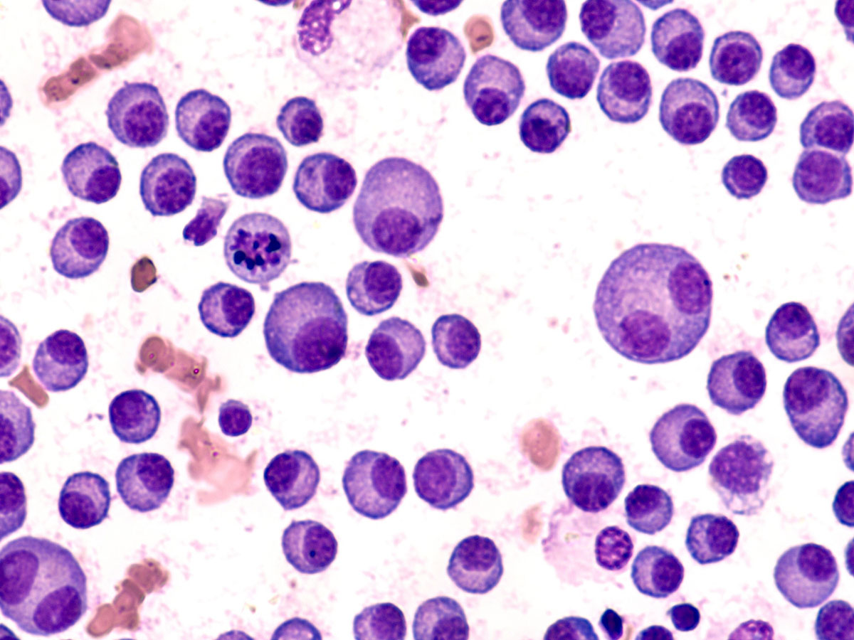 Microscopic view of multiple myeloma cells, showing purple sphere shapes